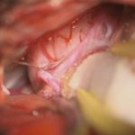 No.’25_81　摘出 前