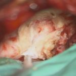 No.’25_81　 摘出 中