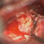 No.’25_81　摘出 後