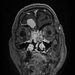 No.’25_88　手術前2