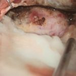 No.’25_88　摘出 前