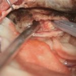 No.’25_88　 摘出 中