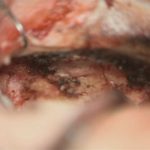 No.’25_88　摘出 後