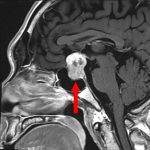 No.’25_85　手術前1