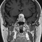 No.’25_85　手術前2