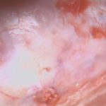 No.’25_85　摘出 前