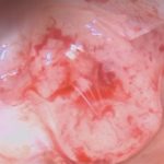 No.’25_85　 摘出 中