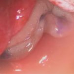 No.’25_85　摘出 後