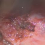 No.’25_105　摘出 前