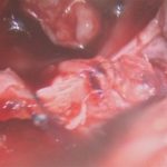 No.’25_105　 摘出 中