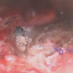 No.’25_105　摘出 後