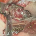 No.’25_82　摘出 前