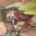 No.’25_82　 摘出 中