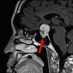 No.’25_93　手術前1