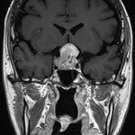 No.’25_93　手術前2