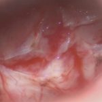 No.’25_93　摘出 前