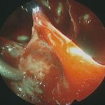 No.’25_93　 摘出 中