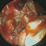 No.’25_93　摘出 後