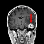 No.’25_87　手術前1