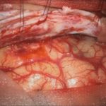 No.’25_87　摘出 前