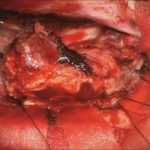 No.’25_87　 摘出 中