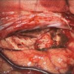 No.’25_87　摘出 後