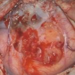 No.’25_89　摘出 前