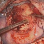 No.’25_89　 摘出 中