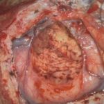 No.’25_89　摘出 後