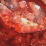 No.’26_21　摘出 前