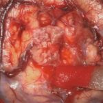 No.’26_21　 摘出 中