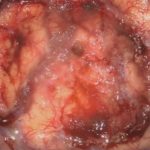 No.’26_21　摘出 後