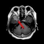 No.’25_90　手術前1