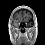 No.’25_90　手術前2