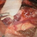 No.’25_90　摘出 前