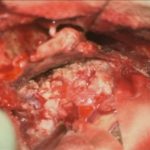 No.’25_90　 摘出 中