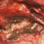 No.’25_90　摘出 後