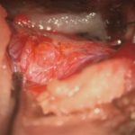 No.’26_19　摘出 前