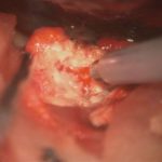 No.’26_19　 摘出 中