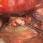 No.’26_19　摘出 後