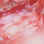 No.’25_96　摘出 前