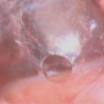 No.’25_96　 摘出 中