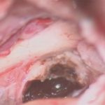 No.’25_96　摘出 後