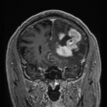 No.’25_95　手術前2