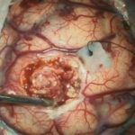 No.’25_95　摘出 前