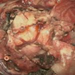 No.’25_95　 摘出 中