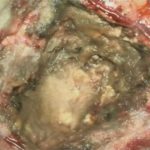 No.’25_95　摘出 後