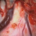 No.’25_101　摘出 前