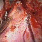 No.’25_101　 摘出 中