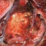 No.’25_101　摘出 後